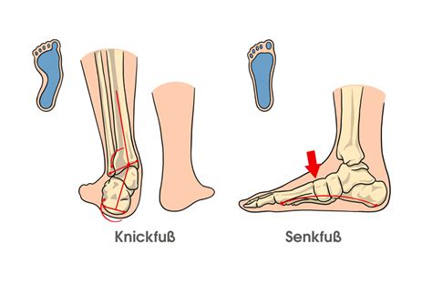 knick-senkfuß joggen